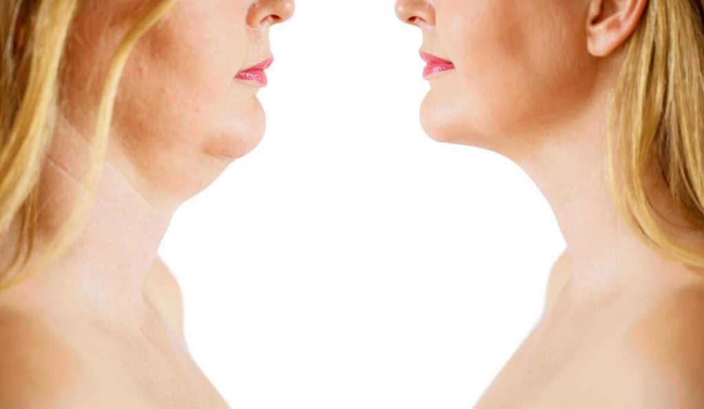 Double Chin treatment West Yorkshire before and after results