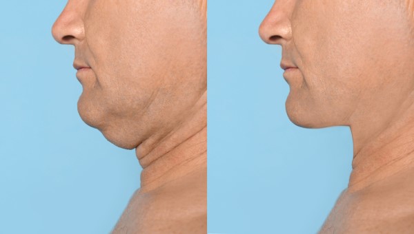 Which Non-Surgical Treatments Work Best for Jowls and Loose Skin West Yorkshire?