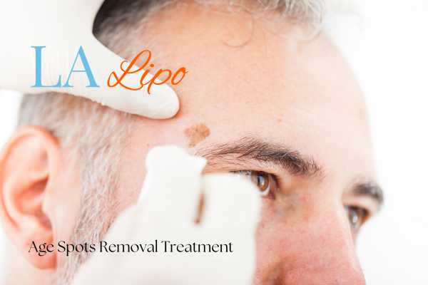 What Are the Most Effective Treatments for Age Spots West Yorkshire?