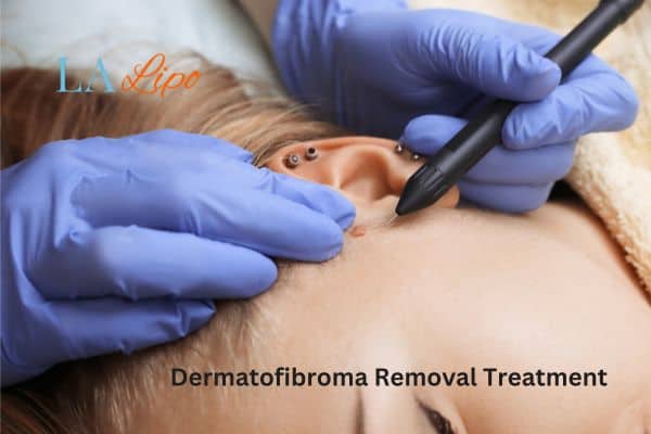 Dermatofibroma Removal Treatment West Yorkshire