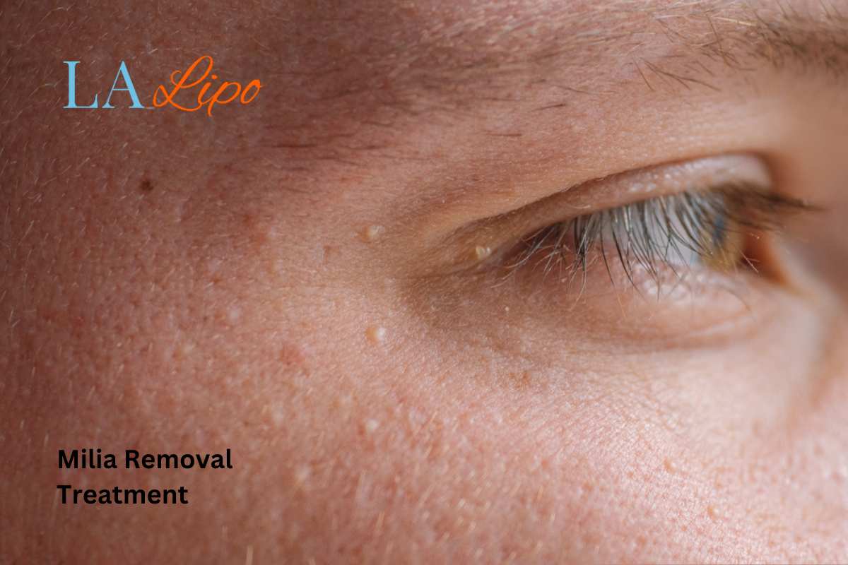 Cryopen Milia Removal: Is It the Easiest and Safest Option West Yorkshire?