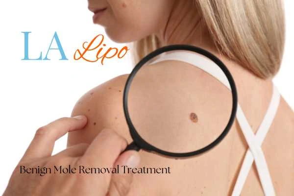 Woman having her inspection of blemish before mole removal West Yorkshire