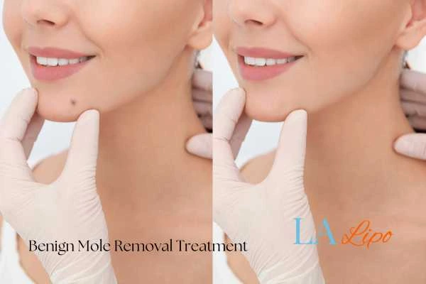 woman's before and after mole removal West Yorkshire results
