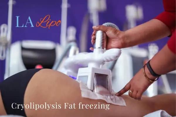 women getting fat freezing West Yorkshire