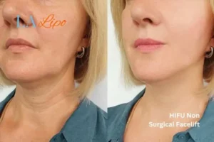 hi-fu for wrinkles West Yorkshire before and after results