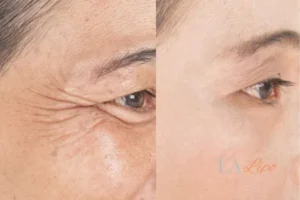 Before and after results of woman - HI-fu wrinkles reduction treatment West Yorkshire