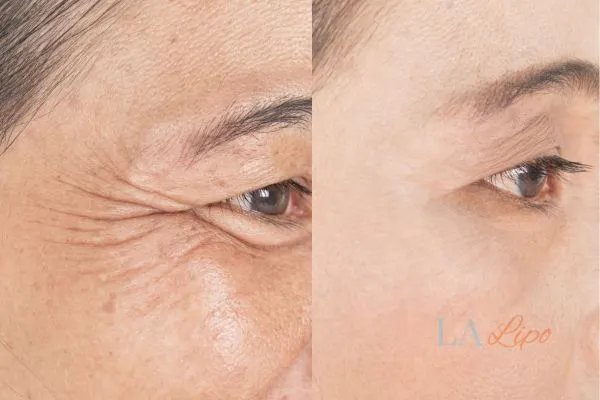 Before and after results of woman - HI-fu wrinkles reduction treatment West Yorkshire