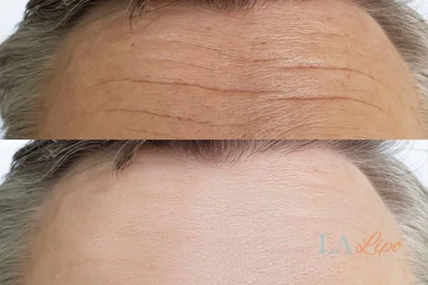 results of HIFU West Yorkshire on mans forehead to help reduce lines and wrinkles