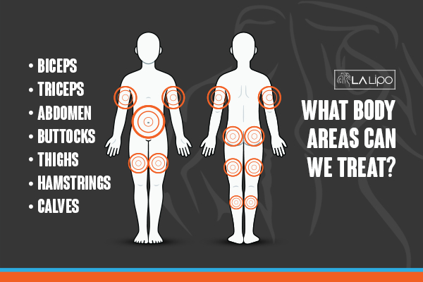 Graphic to show areas you can have LA-EMS Body Sculpting West Yorkshire treatment.