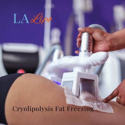 fat freezing - Cryolipolysis West Yorkshire