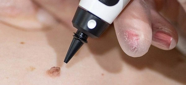 skin tag removal using cryopen West Yorkshire