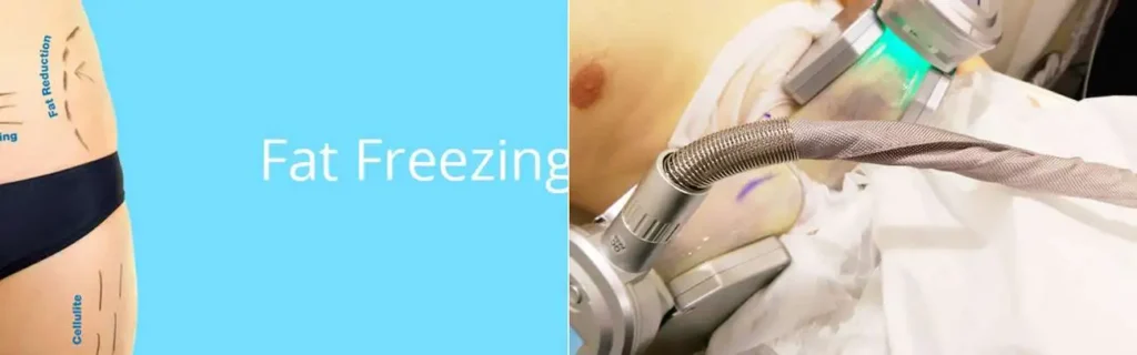 multi areas of a persons body having coolsculpting West Yorkshire treatment
