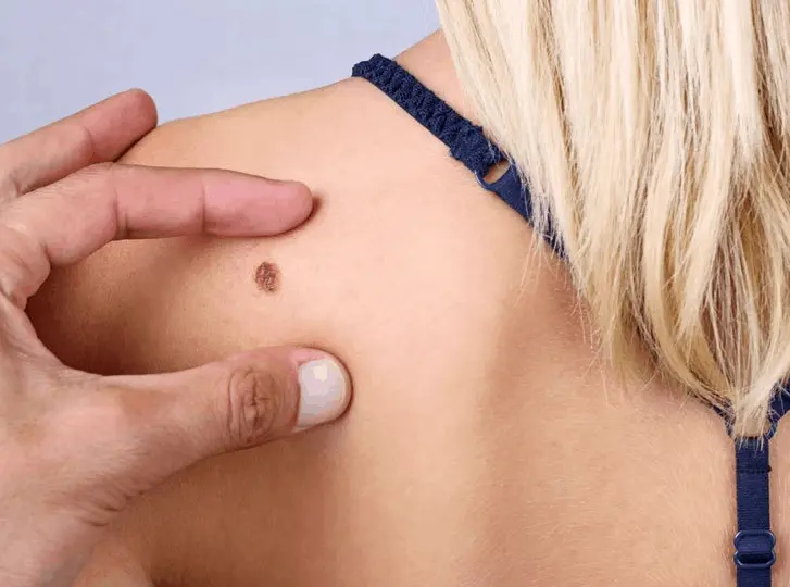 woman having mole removal West Yorkshire consultation before treatment.