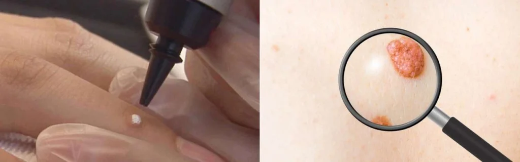Person getting moles removed with cryopen West Yorkshire
