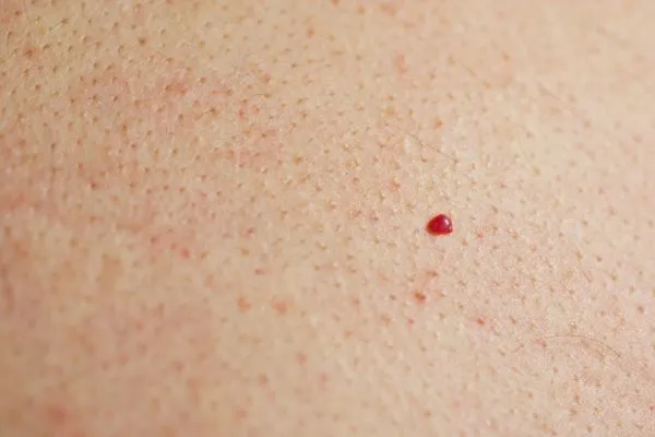 close up of a cherry angioma West Yorkshire