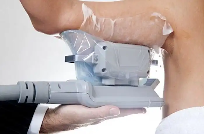 Picture of fat freezing West Yorkshire on the upper arms.