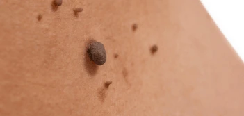 image of a skin tag West Yorkshire