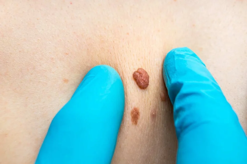 Consultant examining a skin tag West Yorkshire