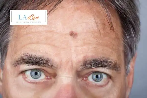 Solar Lentigo Removal West Yorkshire image of man with mark on his forehead