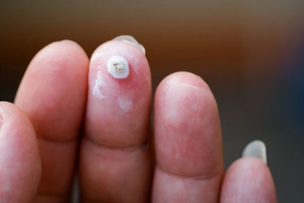 wart on person finger - cryotherapy to treat from LA LIPO West Yorkshire