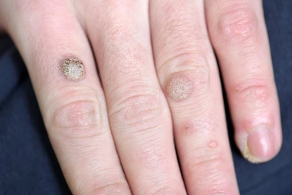 photo of warts on person hand - see wart removal West Yorkshire from LA LIPO
