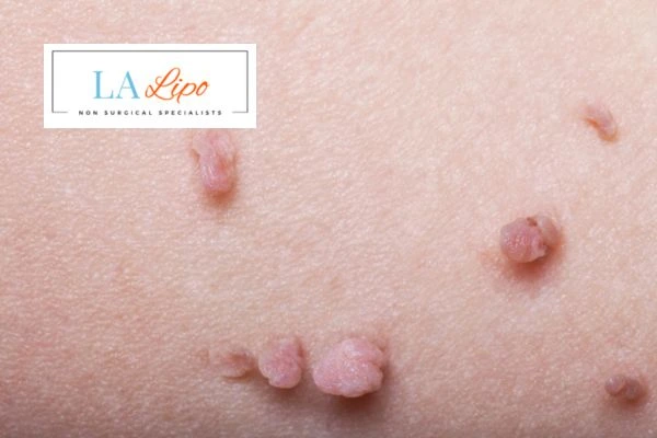 Does cryopen skin tag removal West Yorkshire hurt? Find out now call our team today!