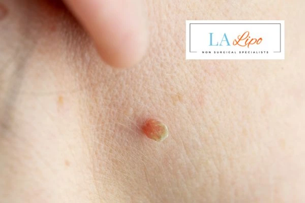 Book skin tag removal West Yorkshire today speak to our team now!