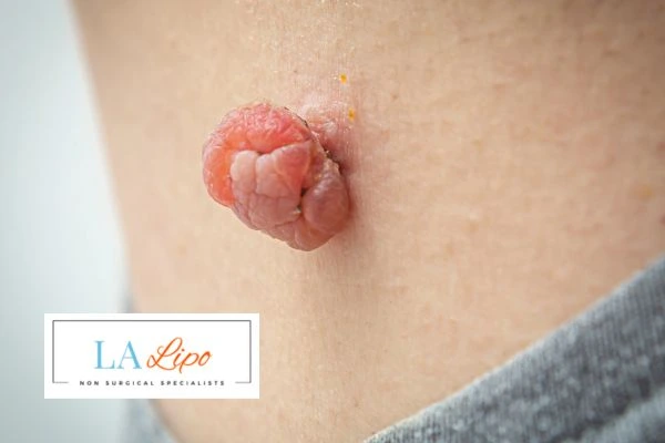 Interested in skin tag removal West Yorkshire? Concerned about the pain? Find out more today!