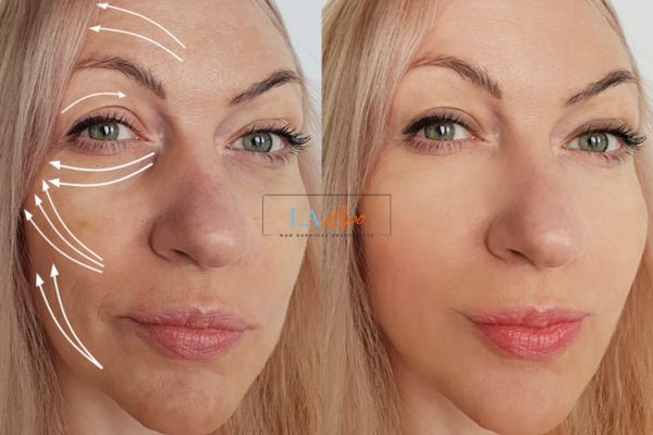 Morpheus 8 results West Yorkshire face lift.