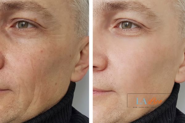 See the amazing results of Morpheus8 Treatment West Yorkshire!