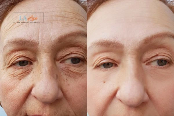 The powerful benefits of Morpheus8 Treatment West Yorkshire - Call Our team today!