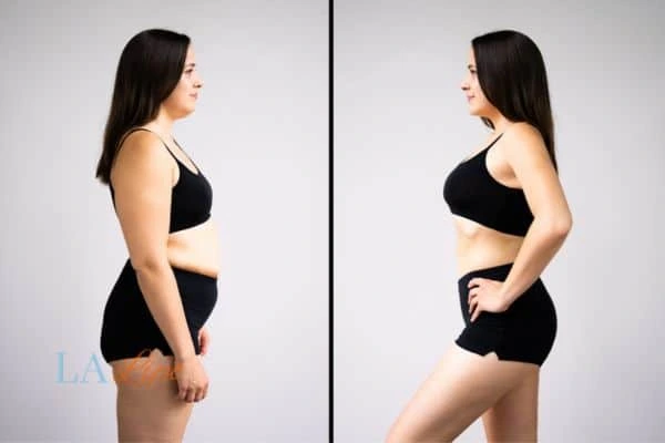 Picture of womans before and after using LA-EMS body sculpting to improve her core strength West Yorkshire