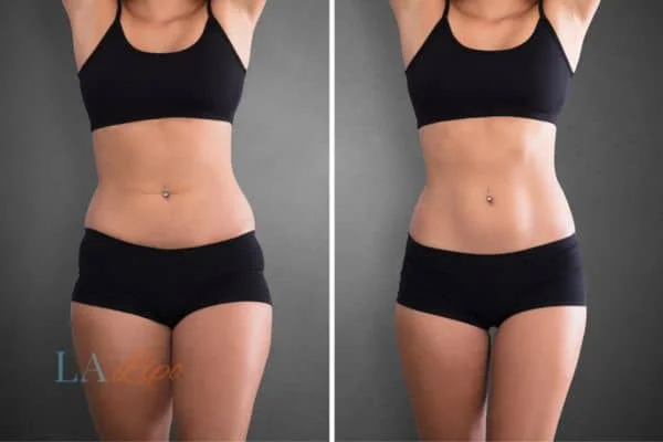 before and after results of non-surgical treatment to help a woman's body image and mental health West Yorkshire