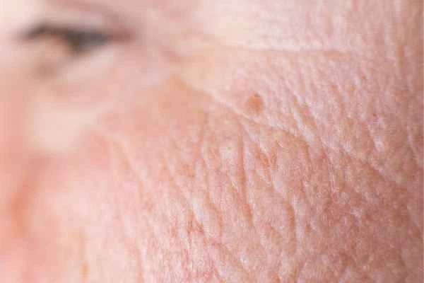 close up picture of a woman's face showing an age spot West Yorkshire