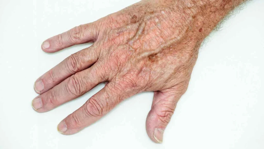 Male hand showing age spot West Yorkshire