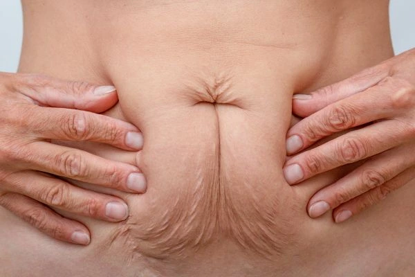 Image of a woman's stomach with loose skin - example of skin tightening West Yorkshire options