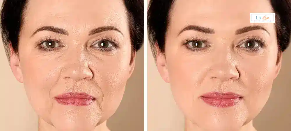 How Long Does It Take to See Results and How Long Do They Last West Yorkshire?
