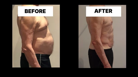 What Symptoms Can Diastasis Recti Cause in Men? Weak Core, Back Pain and Poor Posture West Yorkshire